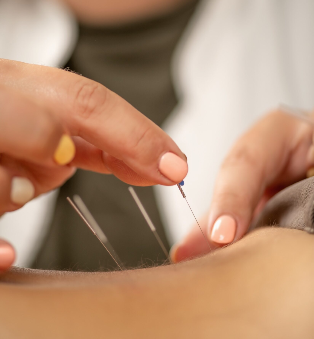 Acupuncture for lower back pain 2024 10 18 19 32 58 utc