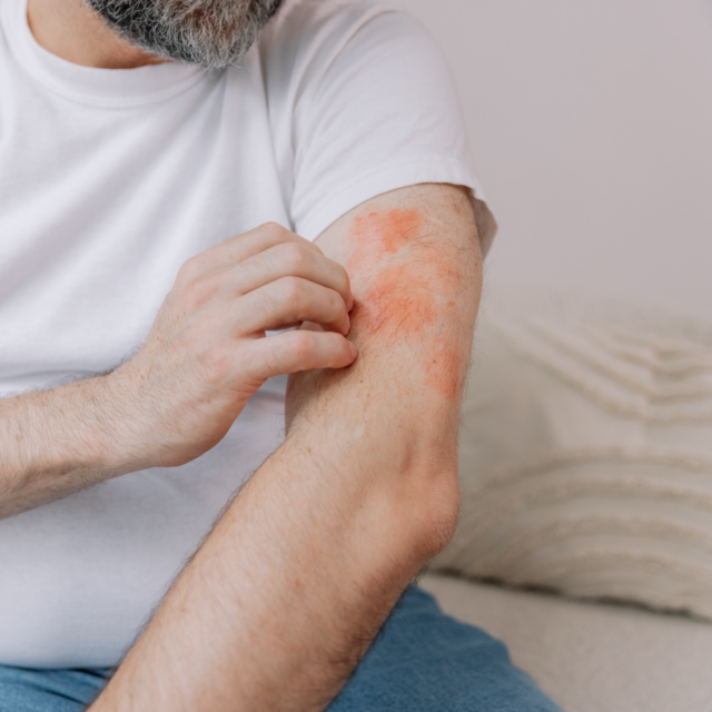 Close up shot of senior man scratching forearm 2025 02 16 20 27 43 utc